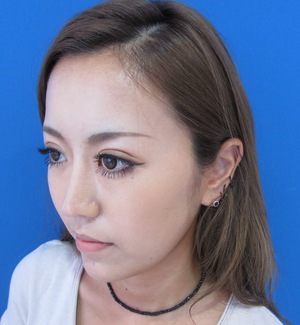目の下のたるみ、目のくまでお悩みの方、切らずに完璧に解決します。TCB-R法　手術直後　症例写真